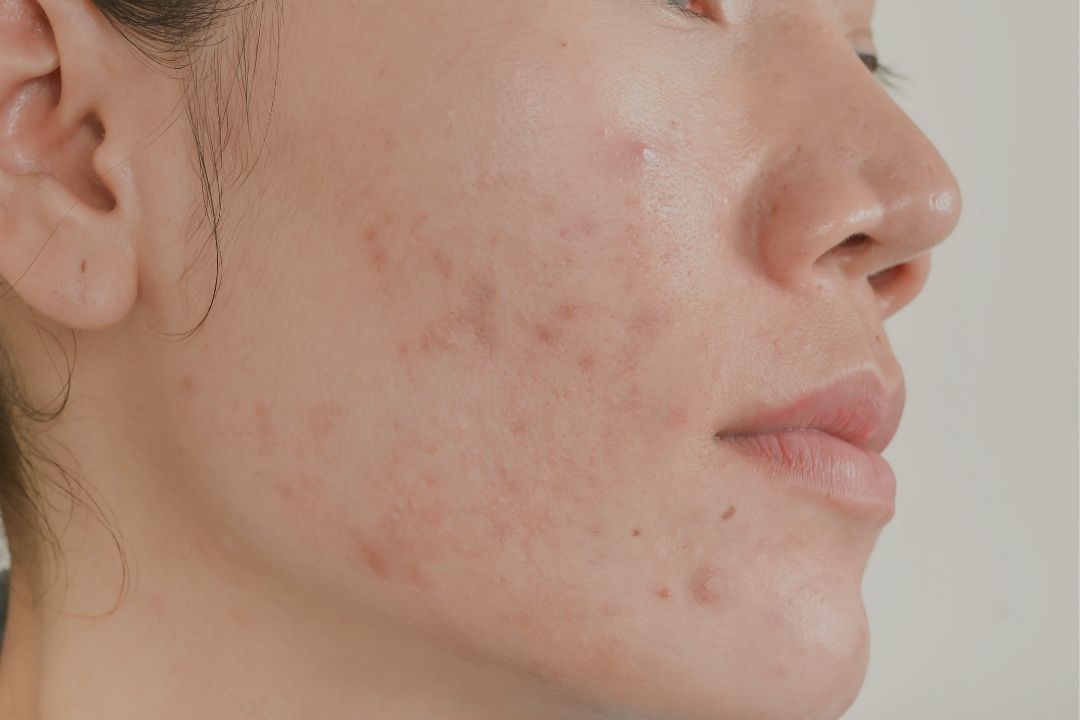 5 Tips to Bid Farewell to Period Acne