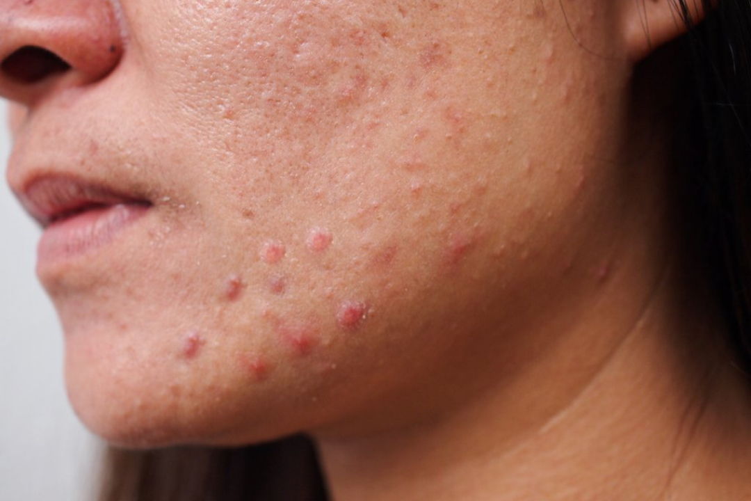 How to Prevent "Post-Christmas Skin"