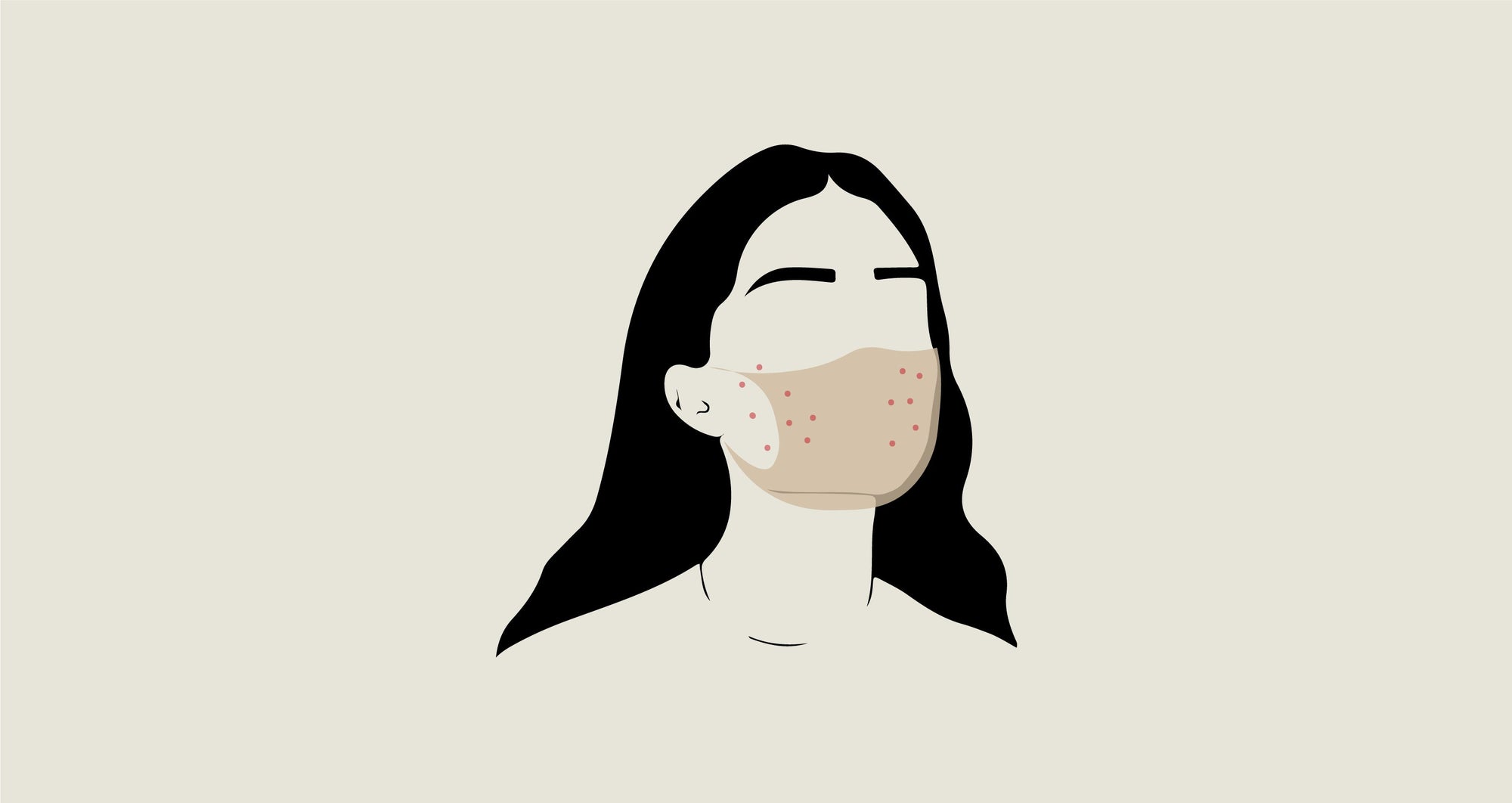 MASK-INDUCED ACNE (MASKNE): WHAT IT IS AND HOW TO TREAT IT